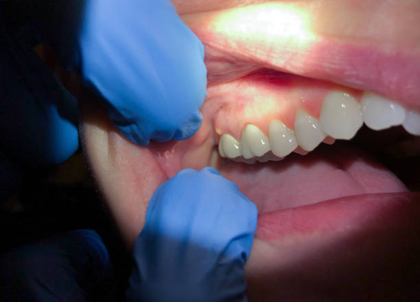 Best Emergency Tooth Extraction in Helotes, TX